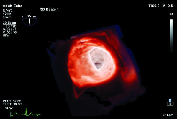 Mitral 3D